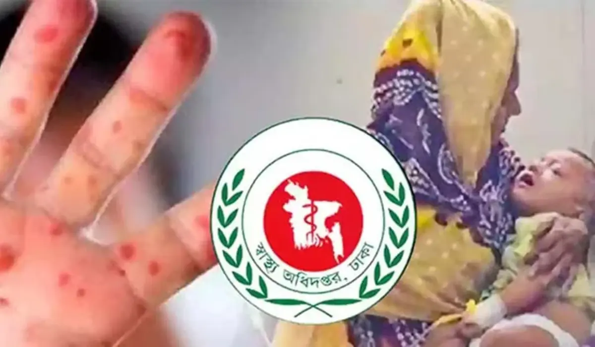 হাম ও উপসর্গে ২৪ ঘণ্টায় আরও ৫ শিশুর মৃত্যু, আক্রান্ত ১,০২৫